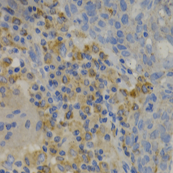 PAK1 Antibody - Immunohistochemistry of paraffin-embedded human lung cancer tissue.