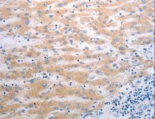 PAK1 Antibody - Immunohistochemistry of paraffin-embedded Human liver cancer using PAK1 Polyclonal Antibody at dilution of 1:40.
