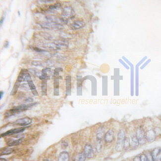 PAK1 Antibody - 1/100 staining human colon  tissue by IHC-P. The sample was formaldehyde fixed and a heat mediated antigen retrieval step in citrate buffer was performed. The sample was then blocked and incubated with the antibody for 1.5 hours at 22°C. An HRP conjugated goat anti-rabbit antibody was used as the secondary antibody.