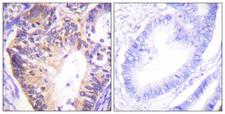 PAK1 Antibody - Peptide - + Immunohistochemistry analysis of paraffin-embedded human colon carcinoma tissue using PAK1 (Ab-212) antibody.