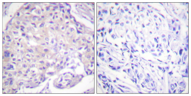 PAK1 Antibody - Immunohistochemistry analysis of paraffin-embedded human breast carcinoma, using PAK1 (Phospho-Thr212) Antibody. The picture on the right is blocked with the phospho peptide.
