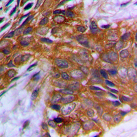 PAK1 Antibody - Immunohistochemical analysis of PAK1 (pT212) staining in human prostate cancer formalin fixed paraffin embedded tissue section. The section was pre-treated using heat mediated antigen retrieval with sodium citrate buffer (pH 6.0). The section was then incubated with the antibody at room temperature and detected using an HRP conjugated compact polymer system. DAB was used as the chromogen. The section was then counterstained with hematoxylin and mounted with DPX.