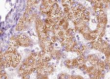 PAK1 Antibody - 1:100 staining human liver carcinoma tissues by IHC-P. The tissue was formaldehyde fixed and a heat mediated antigen retrieval step in citrate buffer was performed. The tissue was then blocked and incubated with the antibody for 1.5 hours at 22°C. An HRP conjugated goat anti-rabbit antibody was used as the secondary.