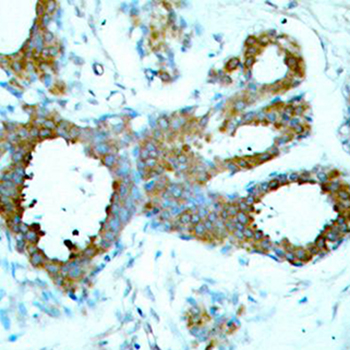 PAK1 Antibody - Immunohistochemistry of paraffin-embedded human breast carcinoma tissue.
