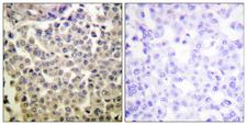 PAK1 + PAK2 + PAK3 Antibody - Immunohistochemistry analysis of paraffin-embedded human breast carcinoma, using PAK1/2/3 (Phospho-Thr423/402/421) Antibody. The picture on the right is blocked with the phospho peptide.