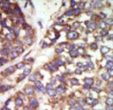 PAK2 Antibody - Formalin-fixed and paraffin-embedded human cancer tissue reacted with the primary antibody, which was peroxidase-conjugated to the secondary antibody, followed by DAB staining. This data demonstrates the use of this antibody for immunohistochemistry; clinical relevance has not been evaluated. BC = breast carcinoma; HC = hepatocarcinoma.