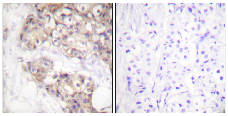 PAK2 Antibody - Immunohistochemistry analysis of paraffin-embedded human breast carcinoma tissue, using PAK2 Antibody. The picture on the right is blocked with the synthesized peptide.