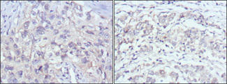 PAK2 Antibody - IHC of paraffin-embedded human lung cancer (left) and gastric cancer (right) using PAK2 mouse monoclonal antibody with DAB staining.