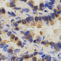 PAK2 Antibody - Immunohistochemical analysis of PAK2 staining in human lung cancer formalin fixed paraffin embedded tissue section. The section was pre-treated using heat mediated antigen retrieval with sodium citrate buffer (pH 6.0). The section was then incubated with the antibody at room temperature and detected using an HRP polymer system. DAB was used as the chromogen. The section was then counterstained with hematoxylin and mounted with DPX.