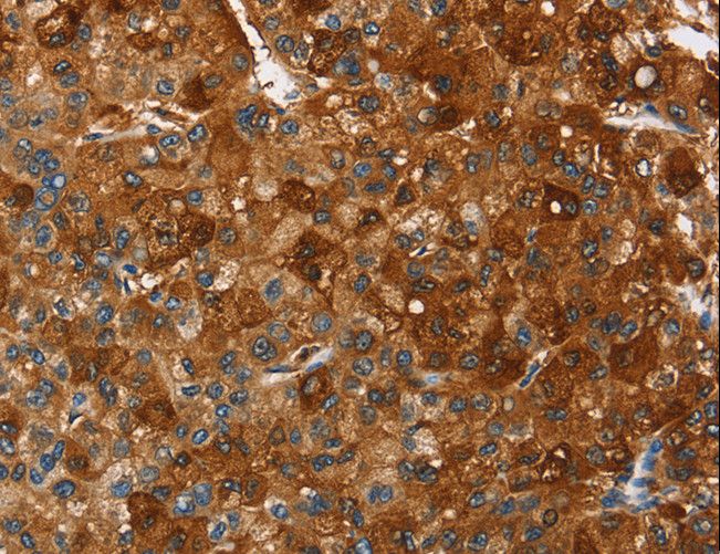 PAK2 Antibody - Immunohistochemistry of paraffin-embedded Human liver cancer using PAK2 Polyclonal Antibody at dilution of 1:40.