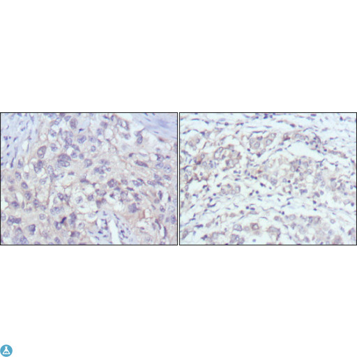 PAK2 Antibody - Immunohistochemistry (IHC) analysis of paraffin-embedded human lung cancer (left) and gastric cancer (right) with DAB staining using PAKgamma Monoclonal Antibody.