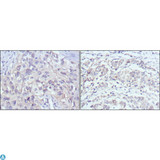 PAK2 Antibody - Immunohistochemistry (IHC) analysis of paraffin-embedded human lung cancer (left) and gastric cancer (right) with DAB staining using PAKgamma Monoclonal Antibody.