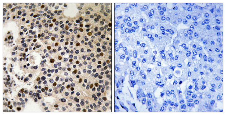 PAK2 Antibody - Immunohistochemistry analysis of paraffin-embedded human breast carcinoma, using PAK2 (Phospho-Ser197) Antibody. The picture on the right is blocked with the phospho peptide.