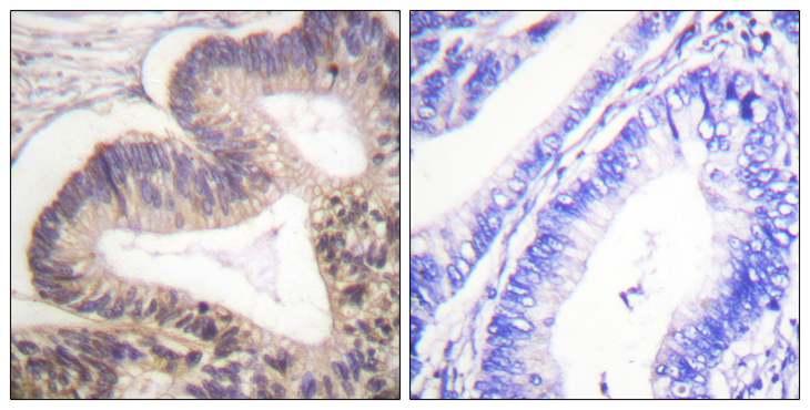 PAK2 Antibody - Immunohistochemistry analysis of paraffin-embedded human colon carcinoma, using PAK2 (Phospho-Ser20) Antibody. The picture on the right is blocked with the phospho peptide.