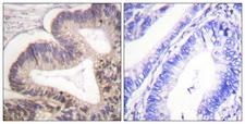 PAK2 Antibody - Immunohistochemistry analysis of paraffin-embedded human colon carcinoma, using PAK2 (Phospho-Ser20) Antibody. The picture on the right is blocked with the phospho peptide.