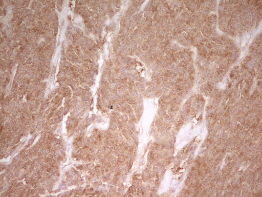 PAK4 Antibody - Immunohistochemical staining of paraffin-embedded Carcinoma of Human lung tissue using anti-PAK4 mouse monoclonal antibody. (Heat-induced epitope retrieval by 1 mM EDTA in 10mM Tris, pH8.5, 120C for 3min,