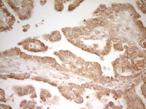 PAK4 Antibody - Immunohistochemical staining of paraffin-embedded Adenocarcinoma of Human ovary tissue using anti-PAK4 mouse monoclonal antibody. (Heat-induced epitope retrieval by 1 mM EDTA in 10mM Tris, pH8.5, 120C for 3min,