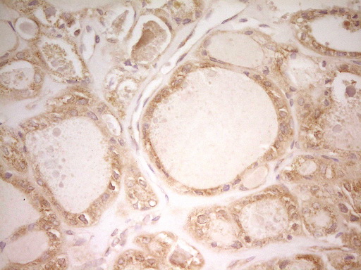 PAK4 Antibody - Immunohistochemical staining of paraffin-embedded Carcinoma of Human thyroid tissue using anti-PAK4 mouse monoclonal antibody. (Heat-induced epitope retrieval by 1 mM EDTA in 10mM Tris, pH8.5, 120C for 3min,