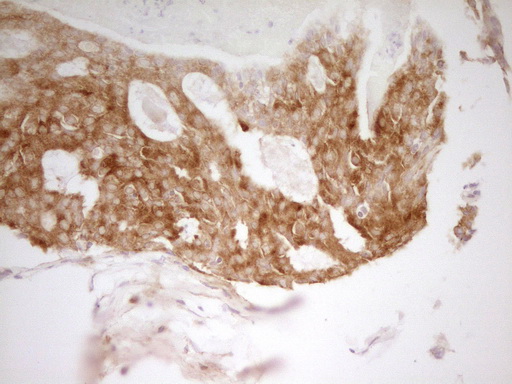 PAK4 Antibody - Immunohistochemical staining of paraffin-embedded Adenocarcinoma of Human breast tissue using anti-PAK4 mouse monoclonal antibody. (Heat-induced epitope retrieval by 1 mM EDTA in 10mM Tris, pH8.5, 120C for 3min,