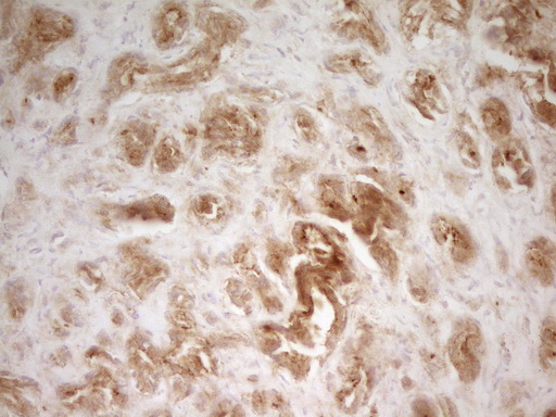 PAK4 Antibody - Immunohistochemical staining of paraffin-embedded Carcinoma of Human prostate tissue using anti-PAK4 mouse monoclonal antibody. (Heat-induced epitope retrieval by 1 mM EDTA in 10mM Tris, pH8.5, 120C for 3min,