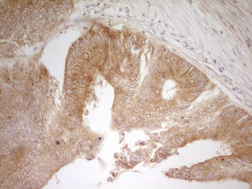 PAK4 Antibody - IHC of paraffin-embedded Adenocarcinoma of Human colon tissue using anti-PAK4 mouse monoclonal antibody. (Heat-induced epitope retrieval by 1 mM EDTA in 10mM Tris, pH8.5, 120°C for 3min).