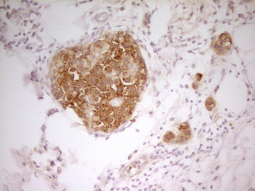 PAK4 Antibody - IHC of paraffin-embedded Carcinoma of Human pancreas tissue using anti-PAK4 mouse monoclonal antibody. (Heat-induced epitope retrieval by 1 mM EDTA in 10mM Tris, pH8.5, 120°C for 3min).
