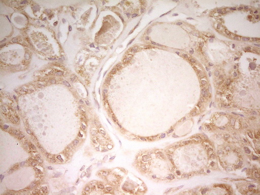 PAK4 Antibody - IHC of paraffin-embedded Carcinoma of Human thyroid tissue using anti-PAK4 mouse monoclonal antibody. (Heat-induced epitope retrieval by 1 mM EDTA in 10mM Tris, pH8.5, 120°C for 3min).