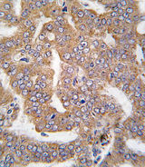 PAK4 Antibody - Formalin-fixed and paraffin-embedded human prostate carcinoma tissue reacted with PAK4 antibody , which was peroxidase-conjugated to the secondary antibody, followed by DAB staining. This data demonstrates the use of this antibody for immunohistochemistry; clinical relevance has not been evaluated.