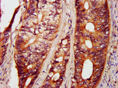 PAK4 Antibody - IHC image of PAK4 Antibody diluted at 1:800 and staining in paraffin-embedded human colon cancer performed on a Leica BondTM system. After dewaxing and hydration, antigen retrieval was mediated by high pressure in a citrate buffer (pH 6.0). Section was blocked with 10% normal goat serum 30min at RT. Then primary antibody (1% BSA) was incubated at 4°C overnight. The primary is detected by a biotinylated secondary antibody and visualized using an HRP conjugated SP system.