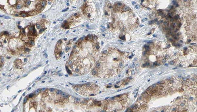 PAK4 Antibody - 1:100 staining human prostate tissue by IHC-P. The sample was formaldehyde fixed and a heat mediated antigen retrieval step in citrate buffer was performed. The sample was then blocked and incubated with the antibody for 1.5 hours at 22°C. An HRP conjugated goat anti-rabbit antibody was used as the secondary.