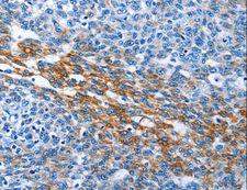 PAK6 Antibody - Immunohistochemistry of paraffin-embedded Human thyroid cancer using PAK6 Polyclonal Antibody at dilution of 1:40.