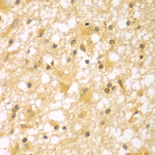 PAK6 Antibody - Immunohistochemistry of paraffin-embedded human brain cancer tissue.
