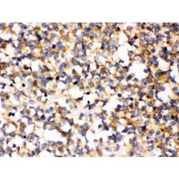 PAK7/PAK5 Antibody - PAK5 antibody IHC-paraffin. IHC(P): Human Glioma Tissue.