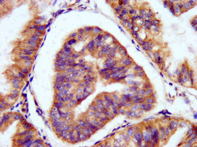 PAL / PAM Antibody - Immunohistochemistry image at a dilution of 1:200 and staining in paraffin-embedded human endometrial cancer performed on a Leica BondTM system. After dewaxing and hydration, antigen retrieval was mediated by high pressure in a citrate buffer (pH 6.0) . Section was blocked with 10% normal goat serum 30min at RT. Then primary antibody (1% BSA) was incubated at 4 °C overnight. The primary is detected by a biotinylated secondary antibody and visualized using an HRP conjugated SP system.