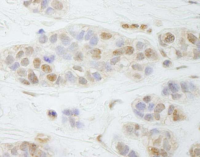 PALB2 Antibody - Detection of Human PALB2 by Immunohistochemistry. Sample: FFPE section of human breast carcinoma. Antibody: Affinity purified rabbit anti-PALB2 used at a dilution of 1:250.