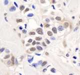 PALB2 Antibody - Detection of Human PALB2 by Immunohistochemistry. Sample: FFPE section of human breast carcinoma. Antibody: Affinity purified rabbit anti-PALB2 used at a dilution of 1:5000 (0.2 ug/ml). Detection: DAB.