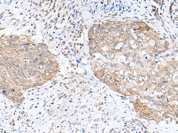 PAM16 Antibody - Immunohistochemistry of paraffin-embedded Human cervical cancer tissue  using PAM16 Polyclonal Antibody at dilution of 1:50(×200)