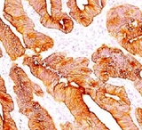 Pan Cytokeratin Antibody - IHC testing of FFPE human colon carcinoma and Multi Cytokeratin antibody (clone C11). This image was taken for the unmodified form of this product. Other forms have not been tested.