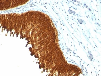 Pan Cytokeratin Antibody - Formalin-fixed, paraffin-embedded human bladder carcinoma stained with Multi Cytokeratin antibody (KRT/457).  This image was taken for the unmodified form of this product. Other forms have not been tested.