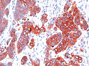 Pan Cytokeratin Antibody - Formalin-fixed, paraffin-embedded human colon carcinoma stained with anti-Multi Cytokeratin antibody (SPM583).  This image was taken for the unmodified form of this product. Other forms have not been tested.