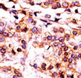 PANK1 / PANK Antibody - Formalin-fixed and paraffin-embedded human cancer tissue reacted with the primary antibody, which was peroxidase-conjugated to the secondary antibody, followed by AEC staining. This data demonstrates the use of this antibody for immunohistochemistry; clinical relevance has not been evaluated. BC = breast carcinoma; HC = hepatocarcinoma.