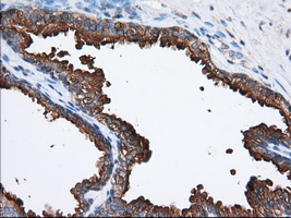 PANK2 Antibody - IHC of paraffin-embedded Carcinoma of Human prostate tissue using anti-PANK2 mouse monoclonal antibody. (Dilution 1:50).