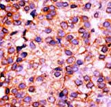 PANK3 Antibody - Formalin-fixed and paraffin-embedded human cancer tissue reacted with the primary antibody, which was peroxidase-conjugated to the secondary antibody, followed by AEC staining. This data demonstrates the use of this antibody for immunohistochemistry; clinical relevance has not been evaluated. BC = breast carcinoma; HC = hepatocarcinoma.