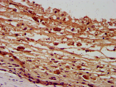 PANX2 / Pannexin 2 Antibody - Immunohistochemistry image at a dilution of 1:400 and staining in paraffin-embedded human melanoma cancer performed on a Leica BondTM system. After dewaxing and hydration, antigen retrieval was mediated by high pressure in a citrate buffer (pH 6.0) . Section was blocked with 10% normal goat serum 30min at RT. Then primary antibody (1% BSA) was incubated at 4 °C overnight. The primary is detected by a biotinylated secondary antibody and visualized using an HRP conjugated SP system.