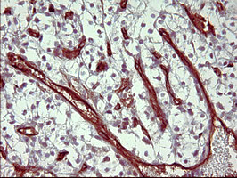PAP2a / PPAP2A Antibody - IHC of paraffin-embedded Carcinoma of Human kidney tissue using anti-PPAP2A mouse monoclonal antibody. (Heat-induced epitope retrieval by 10mM citric buffer, pH6.0, 120°C for 3min).