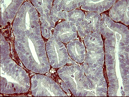 PAP2a / PPAP2A Antibody - IHC of paraffin-embedded Adenocarcinoma of Human endometrium tissue using anti-PPAP2A mouse monoclonal antibody. (Heat-induced epitope retrieval by 10mM citric buffer, pH6.0, 120°C for 3min).