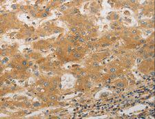 PAP2a / PPAP2A Antibody - Immunohistochemistry of paraffin-embedded Human lung cancer using PPAP2A Polyclonal Antibody at dilution of 1:50.