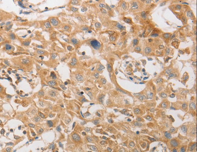 PAP2a / PPAP2A Antibody - Immunohistochemistry of paraffin-embedded Human lung cancer using PPAP2A Polyclonal Antibody at dilution of 1:50.