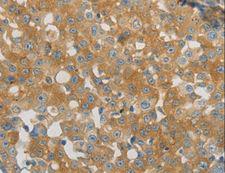 PAP2a / PPAP2A Antibody - Immunohistochemistry of paraffin-embedded Human breast cancer using PPAP2A Polyclonal Antibody at dilution of 1:40.