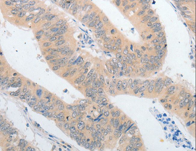 PAP2a / PPAP2A Antibody - Immunohistochemistry of paraffin-embedded Human colon cancer using PPAP2A Polyclonal Antibody at dilution of 1:40.